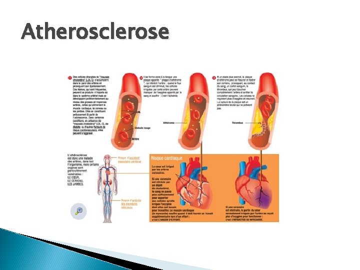 Atherosclerose 
