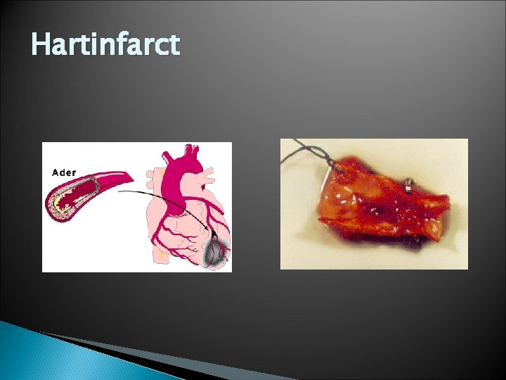 Hartinfarct 