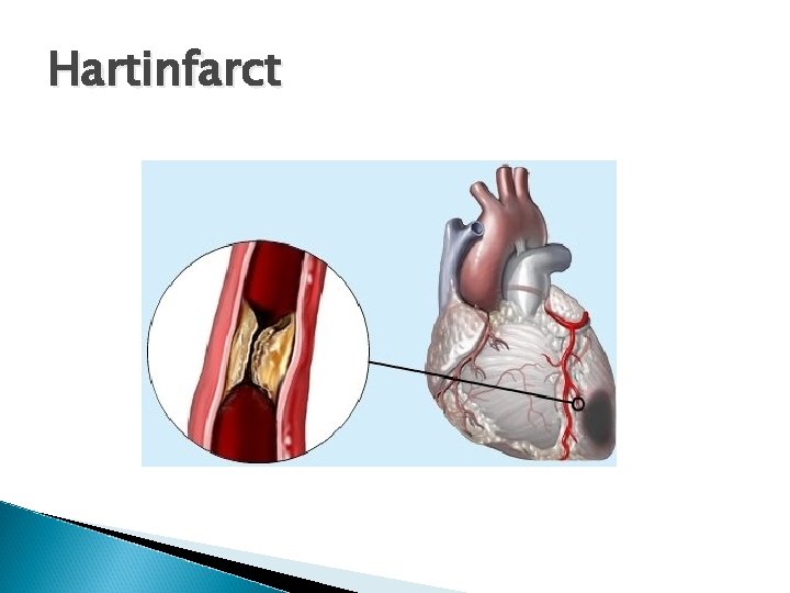 Hartinfarct 