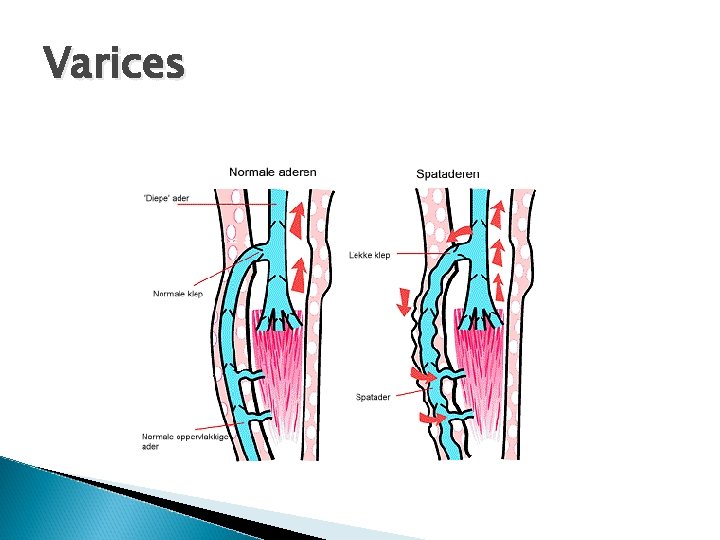 Varices 