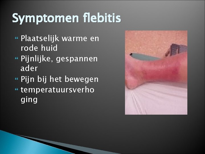 Symptomen flebitis Plaatselijk warme en rode huid Pijnlijke, gespannen ader Pijn bij het bewegen