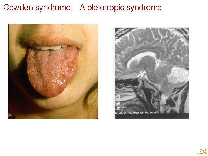 Cowden syndrome. A pleiotropic syndrome 