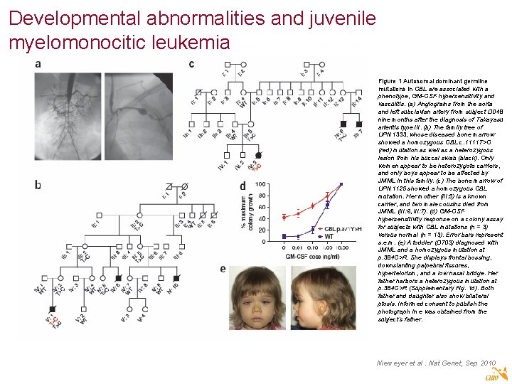Developmental abnormalities and juvenile myelomonocitic leukemia Figure 1 Autosomal dominant germline mutations in CBL