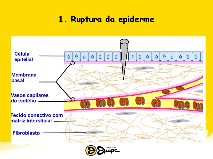 1. Ruptura da epiderme 