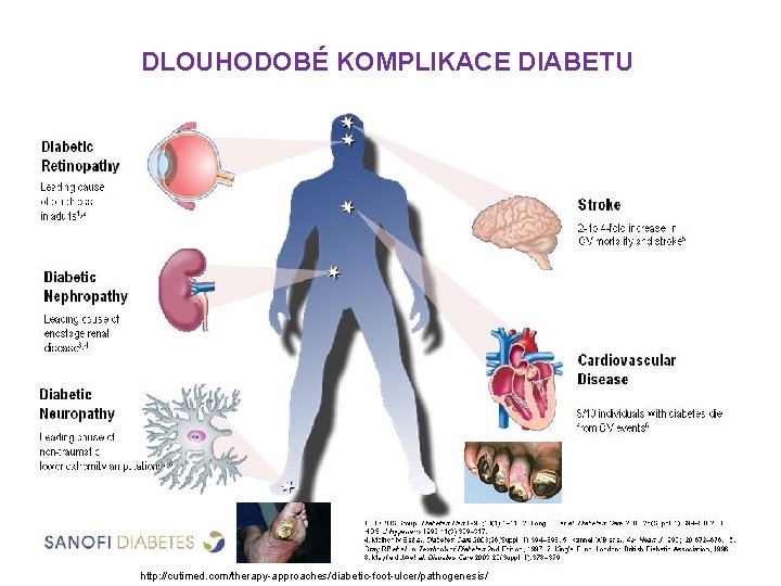 DLOUHODOBÉ KOMPLIKACE DIABETU http: //cutimed. com/therapy-approaches/diabetic-foot-ulcer/pathogenesis/ 