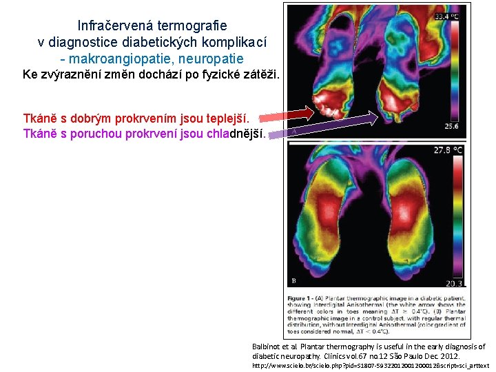 Infračervená termografie v diagnostice diabetických komplikací - makroangiopatie, neuropatie Ke zvýraznění změn dochází po