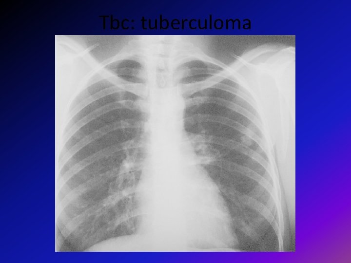 Tbc: tuberculoma 