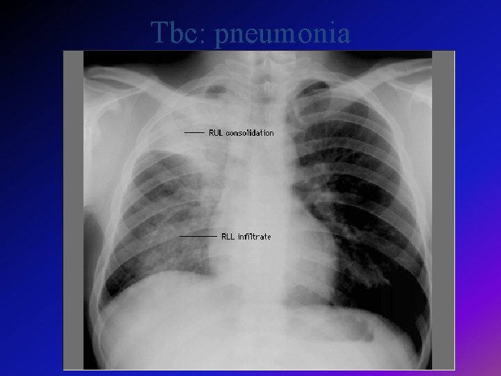 Tbc: pneumonia 