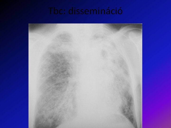 Tbc: dissemináció 