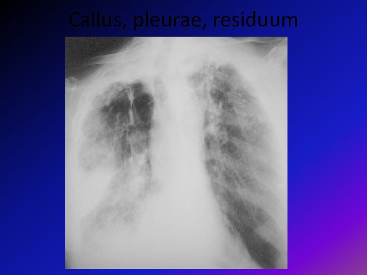 Callus, pleurae, residuum 
