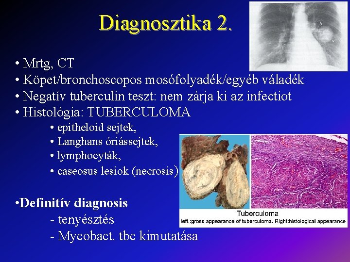 Diagnosztika 2. • Mrtg, CT • Köpet/bronchoscopos mosófolyadék/egyéb váladék • Negatív tuberculin teszt: nem