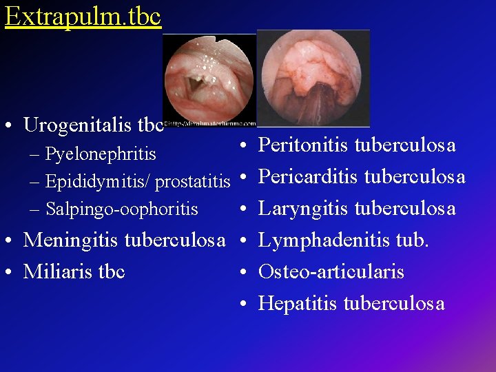 Extrapulm. tbc • Urogenitalis tbc • Peritonitis tuberculosa – Pyelonephritis – Epididymitis/ prostatitis •