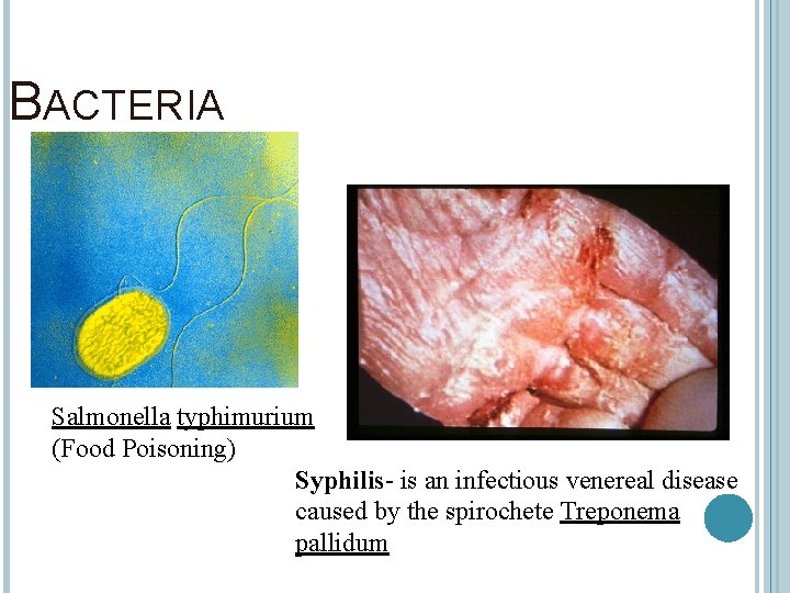 BACTERIA Salmonella typhimurium (Food Poisoning) Syphilis- is an infectious venereal disease caused by the