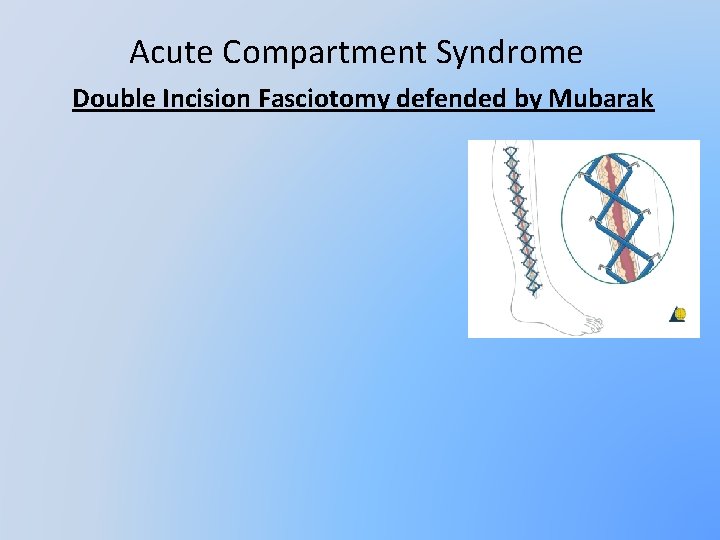 Acute Compartment Syndrome Double Incision Fasciotomy defended by Mubarak 