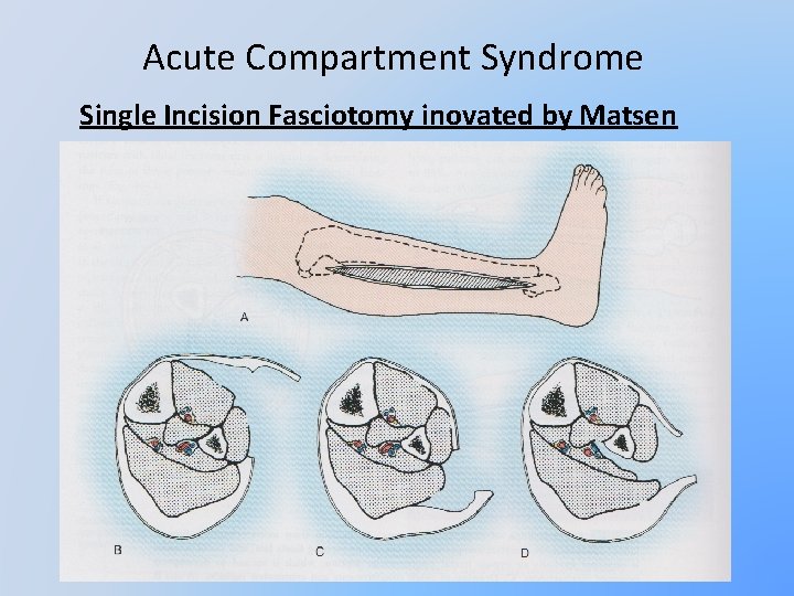 Acute Compartment Syndrome Single Incision Fasciotomy inovated by Matsen 