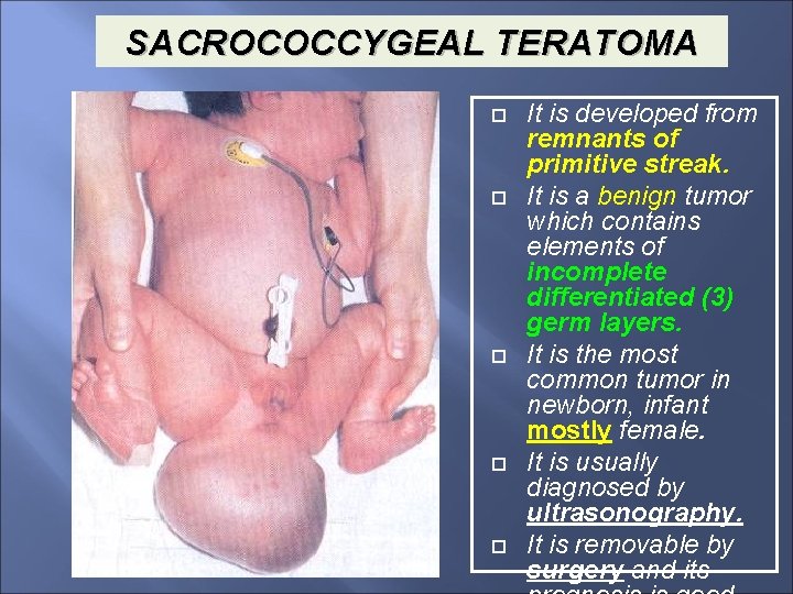 SACROCOCCYGEAL TERATOMA It is developed from remnants of primitive streak. It is a benign