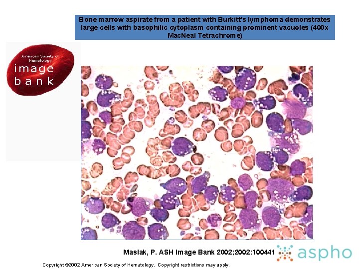 Bone marrow aspirate from a patient with Burkitt's lymphoma demonstrates large cells with basophilic