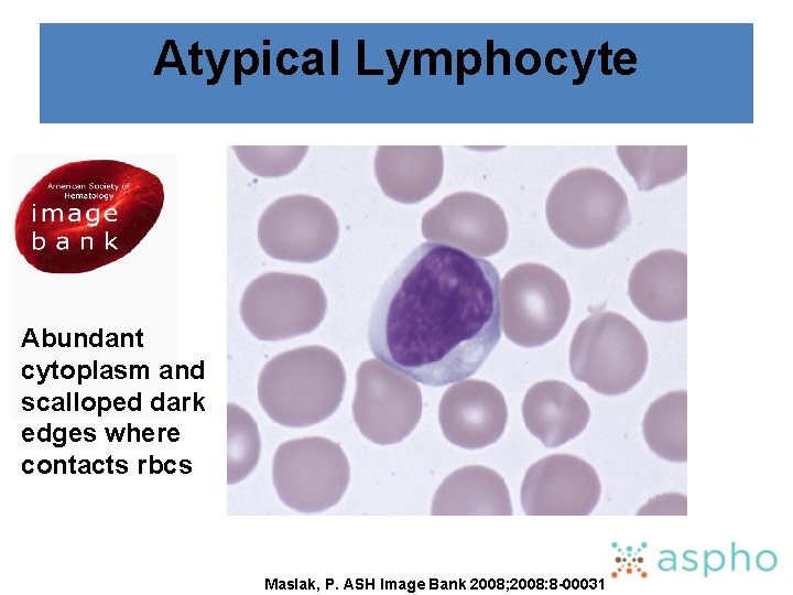 Atypical Lymphocyte Abundant cytoplasm and scalloped dark edges where contacts rbcs Maslak, P. ASH