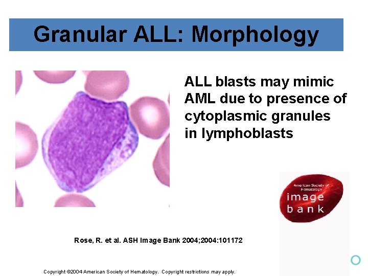 Granular ALL: Morphology ALL blasts may mimic AML due to presence of cytoplasmic granules