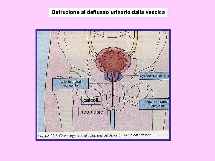 Ostruzione al deflusso urinario dalla vescica calcoli neoplasie 