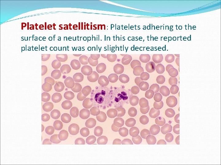 Platelet satellitism: Platelets adhering to the surface of a neutrophil. In this case, the