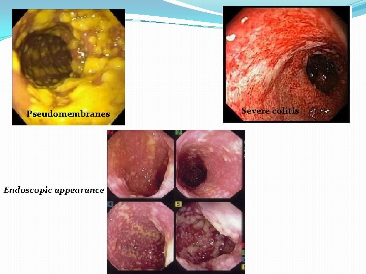  Pseudomembranes Endoscopic appearance Severe colitis 