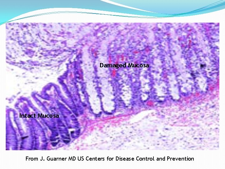 Damaged Mucosa Intact Mucosa From J. Guarner MD US Centers for Disease Control and