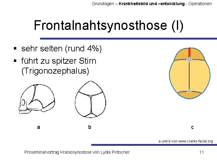 Grundlagen – Krankheitsbild und –entwicklung - Operationen Frontalnahtsynosthose (I) § sehr selten (rund 4%)