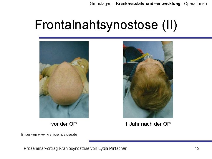 Grundlagen – Krankheitsbild und –entwicklung - Operationen Frontalnahtsynostose (II) vor der OP 1 Jahr