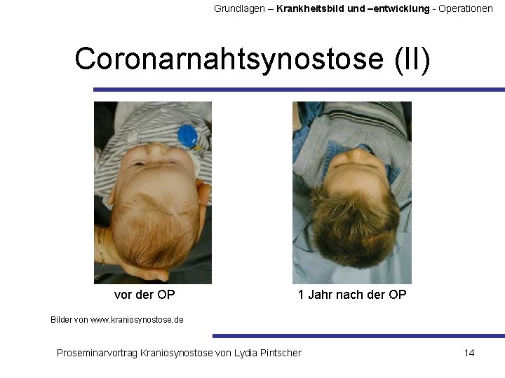 Grundlagen – Krankheitsbild und –entwicklung - Operationen Coronarnahtsynostose (II) vor der OP 1 Jahr