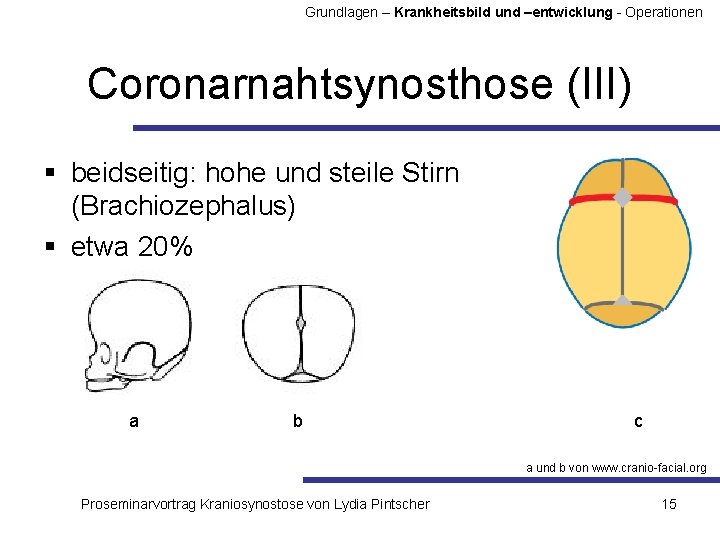 Grundlagen – Krankheitsbild und –entwicklung - Operationen Coronarnahtsynosthose (III) § beidseitig: hohe und steile