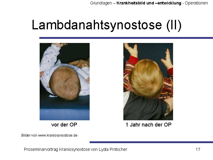 Grundlagen – Krankheitsbild und –entwicklung - Operationen Lambdanahtsynostose (II) vor der OP 1 Jahr