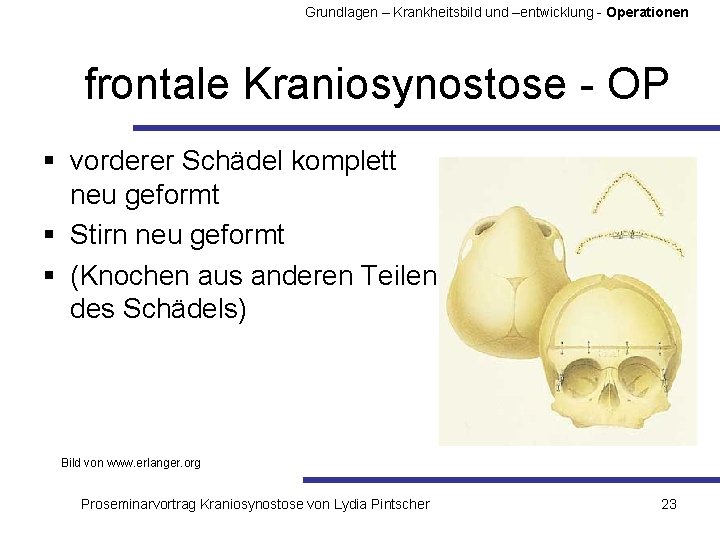 Grundlagen – Krankheitsbild und –entwicklung - Operationen frontale Kraniosynostose - OP § vorderer Schädel