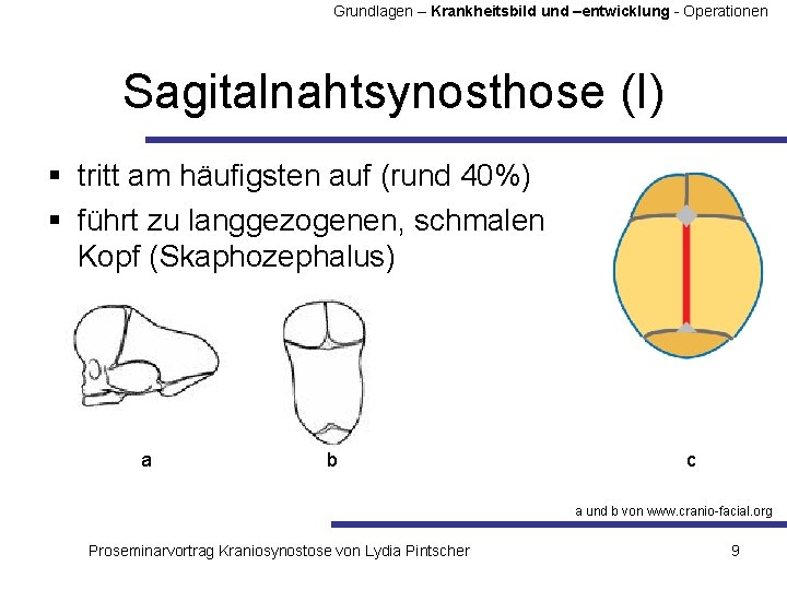 Grundlagen – Krankheitsbild und –entwicklung - Operationen Sagitalnahtsynosthose (I) § tritt am häufigsten auf