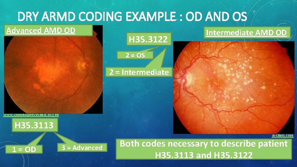 DRY ARMD CODING EXAMPLE : OD AND OS Advanced AMD OD H 35. 3122