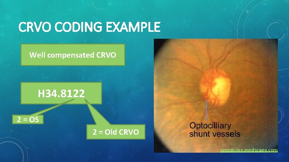 CRVO CODING EXAMPLE Well compensated CRVO H 34. 8122 2 = OS 2 =