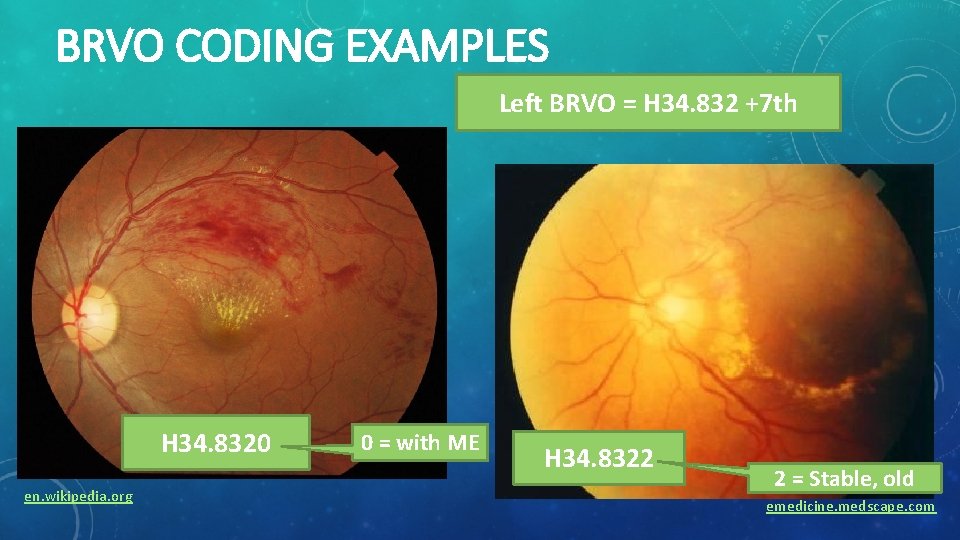 BRVO CODING EXAMPLES Left BRVO = H 34. 832 +7 th H 34. 8320