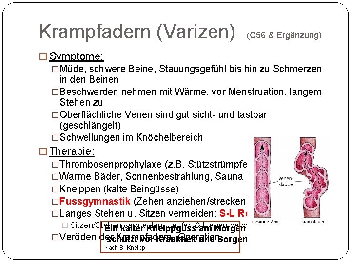 Krampfadern (Varizen) (C 56 & Ergänzung) � Symptome: �Müde, schwere Beine, Stauungsgefühl bis hin