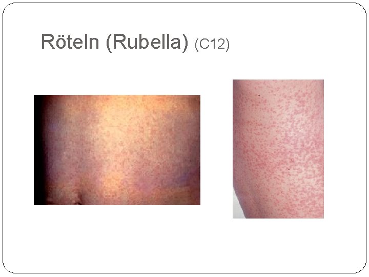 Röteln (Rubella) (C 12) 