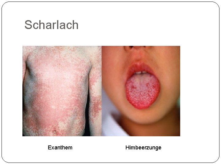 Scharlach Exanthem Himbeerzunge 