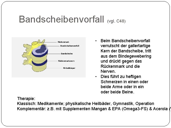 Bandscheibenvorfall (vgl. C 48) • Beim Bandscheibenvorfall verrutscht der gallertartige Kern der Bandscheibe, tritt