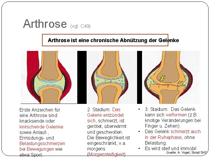 Arthrose (vgl. C 49) Arthrose ist eine chronische Abnützung der Gelenke Erste Anzeichen für