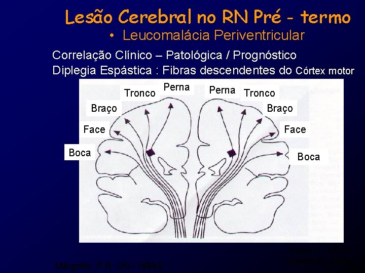 Lesão Cerebral no RN Pré - termo • Leucomalácia Periventricular Correlação Clínico – Patológica