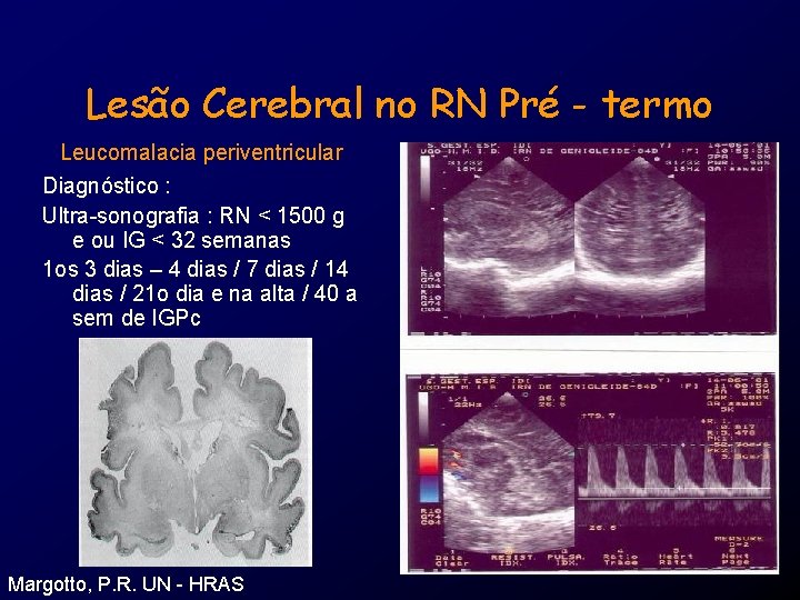 Lesão Cerebral no RN Pré - termo Leucomalacia periventricular Diagnóstico : Ultra-sonografia : RN