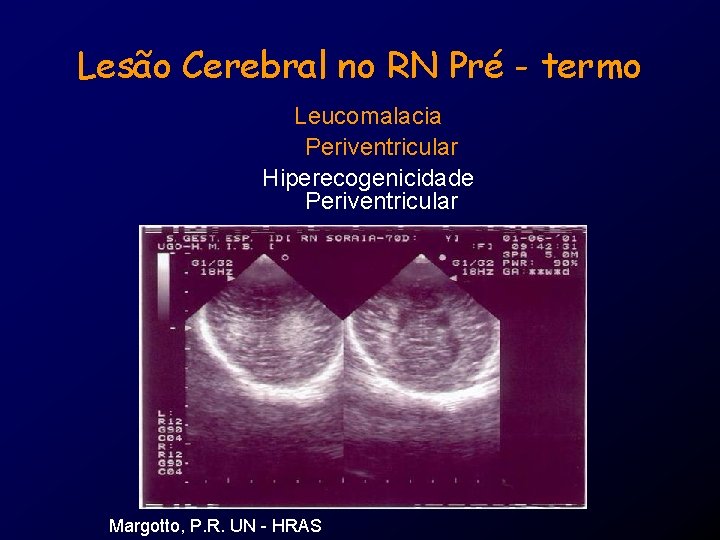 Lesão Cerebral no RN Pré - termo Leucomalacia Periventricular Hiperecogenicidade Periventricular Margotto, P. R.