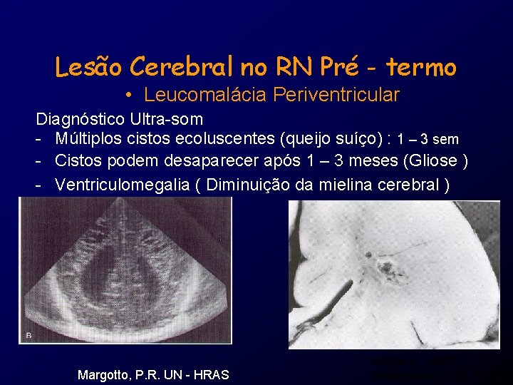 Lesão Cerebral no RN Pré - termo • Leucomalácia Periventricular Diagnóstico Ultra-som - Múltiplos