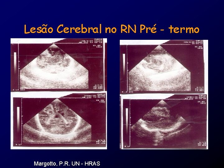 Lesão Cerebral no RN Pré - termo Margotto, P. R. UN - HRAS 