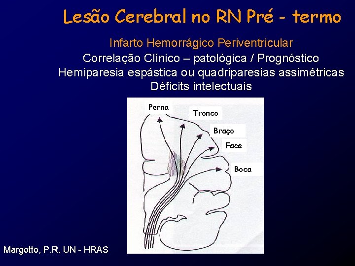 Lesão Cerebral no RN Pré - termo Infarto Hemorrágico Periventricular Correlação Clínico – patológica