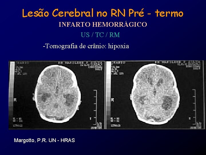 Lesão Cerebral no RN Pré - termo INFARTO HEMORRÁGICO US / TC / RM