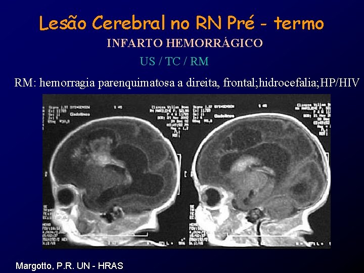 Lesão Cerebral no RN Pré - termo INFARTO HEMORRÁGICO US / TC / RM